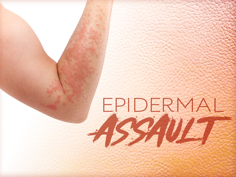 Heat Rash, Jock Itch, Foot Fungus, Tinea Versicolor,, 45 OFF